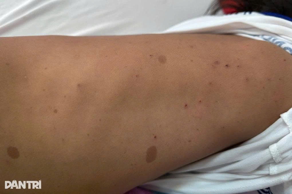 Trên cơ thể còn lại dấu vết của việc bị đàn ong tấn công (Ảnh: Thúy Diễm).