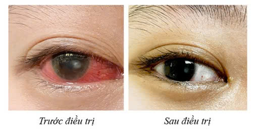 Cô gái Quảng Ninh bị loét giác mạc do lạm dụng kính áp tròng 2 Cô gái đeo kính áp tròng thay kính cận ròng rã 4 năm đã bị loét giác mạc.