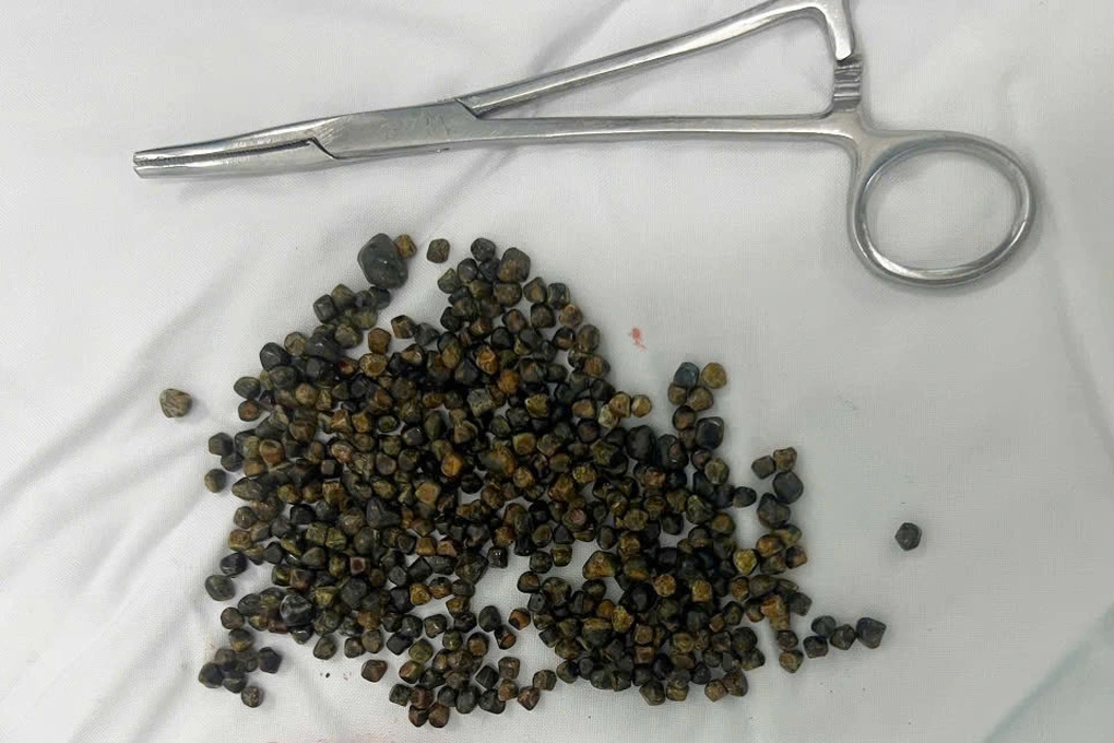 Số lượng sỏi khổng lồ được lấy ra khỏi túi mật của nữ Việt kiều (Ảnh: BS).