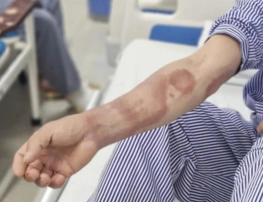 Các tổn thương da trên tay người bố (Ảnh: Mai Hương).