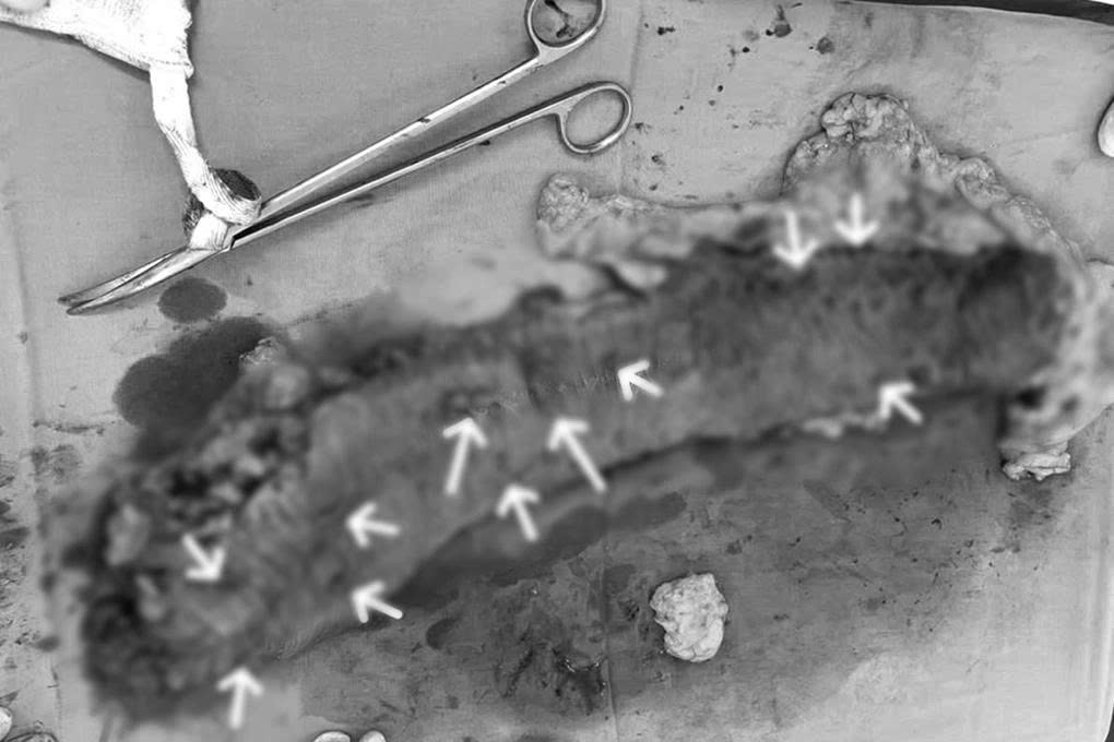 Đại tràng phải của bệnh nhân được cắt đi, ghi nhận các khối u và polyp rải rác (Ảnh: BV).