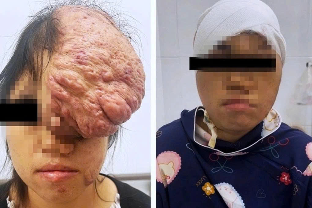 Gương mặt bệnh nhân trước (bên trái) và sau mổ (Ảnh: SYT).