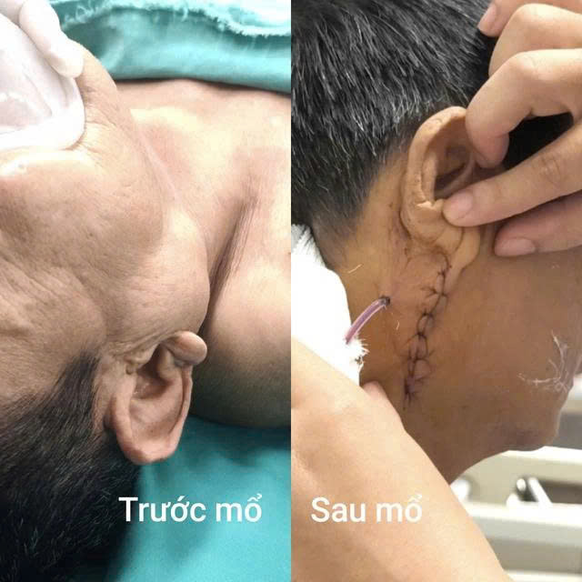 Hà Nội: Cụ ông 70 tuổi tái phát u tuyến nước bọt sau gần 10 năm 2 Hình ảnh trước và sau phẫu thuật của bệnh nhân.