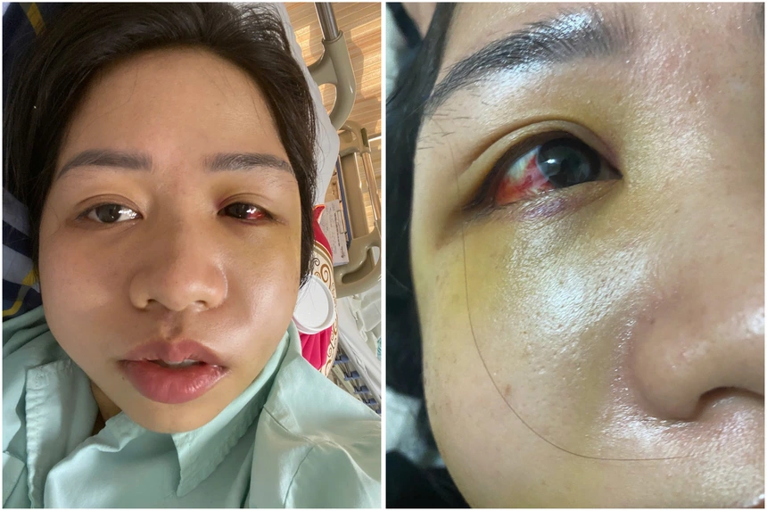 Vụ việc ở Bảo Hà: Ai chịu trách nhiệm khi chó chạy ra đường gây tai nạn? 1 Mặt chị Phạm Thị Ánh biến dạng sau tai nạn.