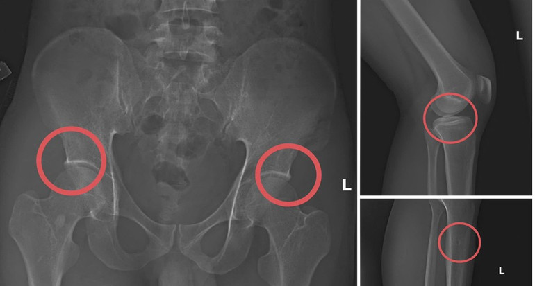 Triệt phá đường dây tự đục vỡ xương, khớp để trục lợi bảo hiểm nhân thọ 2 image 1 1