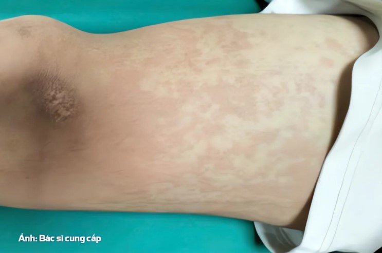Vết ban đỏ trên người bệnh nhân sau khi ăn ve sầu. Ảnh BSCC