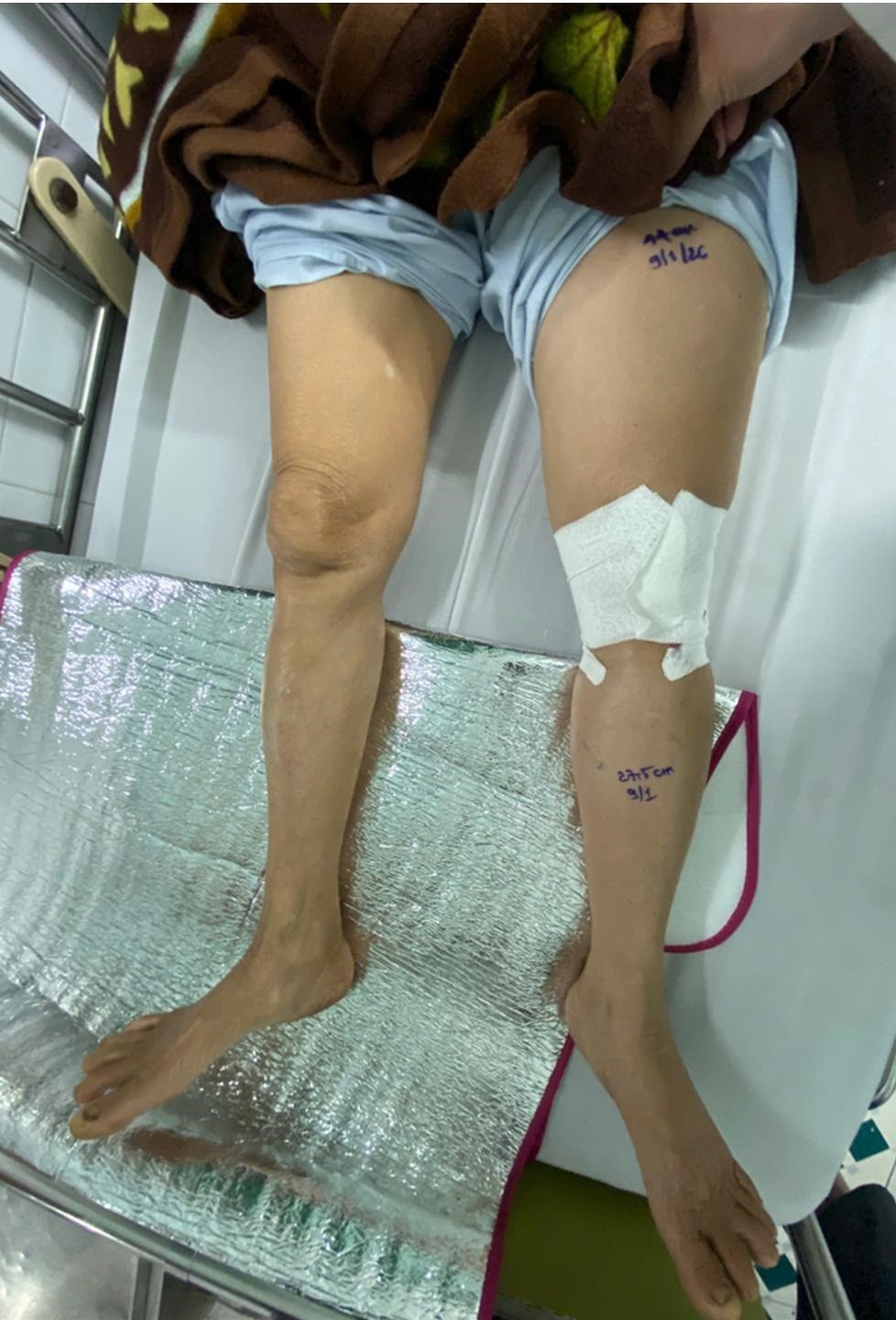 Không xem nhẹ tình trạng phù một bên chân, có thể là dấu hiệu huyết khối nguy hiểm 1 Chân trái sưng to do huyết khối tĩnh mạch sâu lan rộng (Ảnh: BVCC)